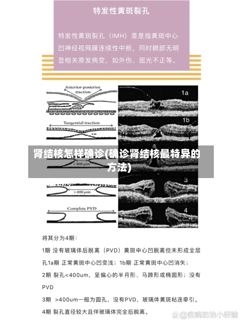 肾结核怎样确诊(确诊肾结核最特异的方法)