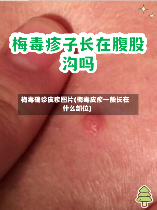 梅毒确诊皮疹图片(梅毒皮疹一般长在什么部位)