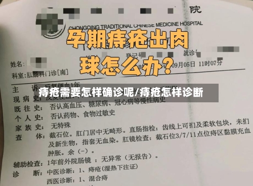 痔疮需要怎样确诊呢/痔疮怎样诊断