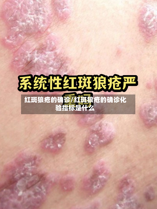 红斑狼疮的确诊/红斑狼疮的确诊化验指标是什么